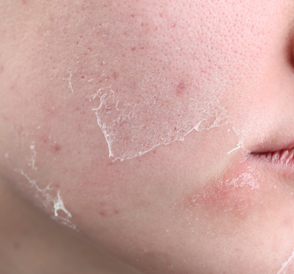 Dehydrated Skin – Makeup2Beauty I Korean Beauty I Beauty Supplier