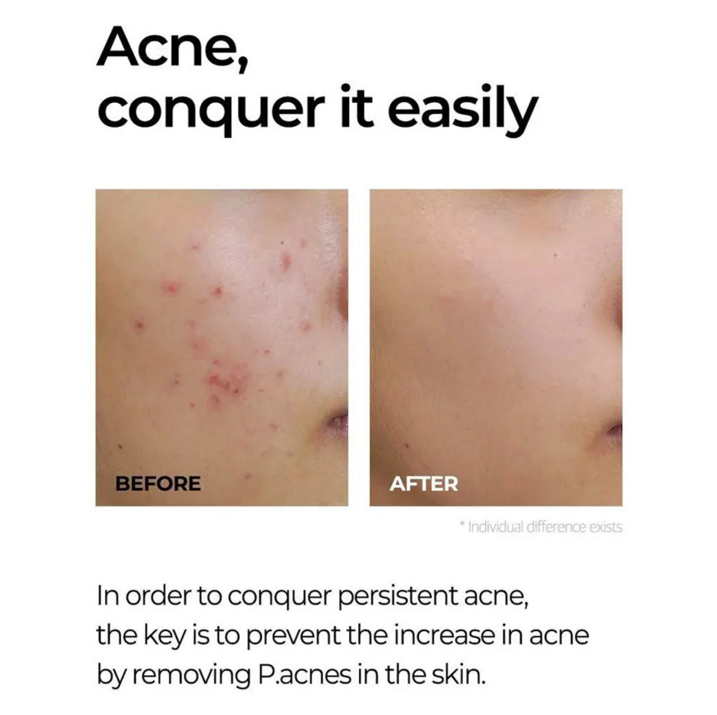SOMEBYMI Miracle AC Spot Treatment - 10g